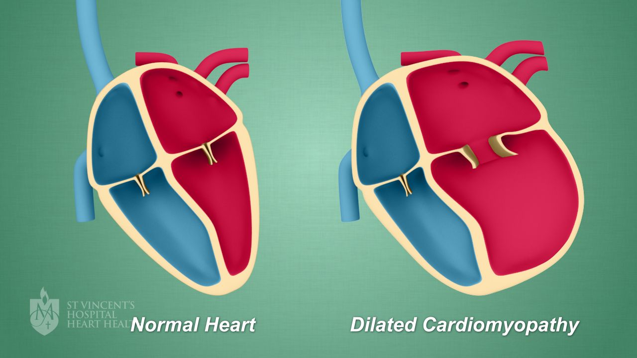 Cardiomyopathy A Disease of the Heart Muscle