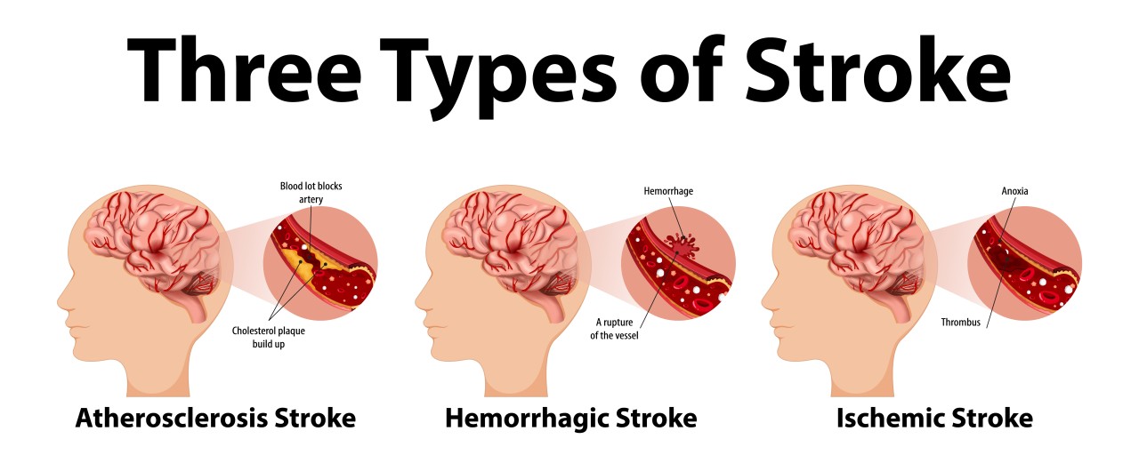 Stroke A Medical Emergency