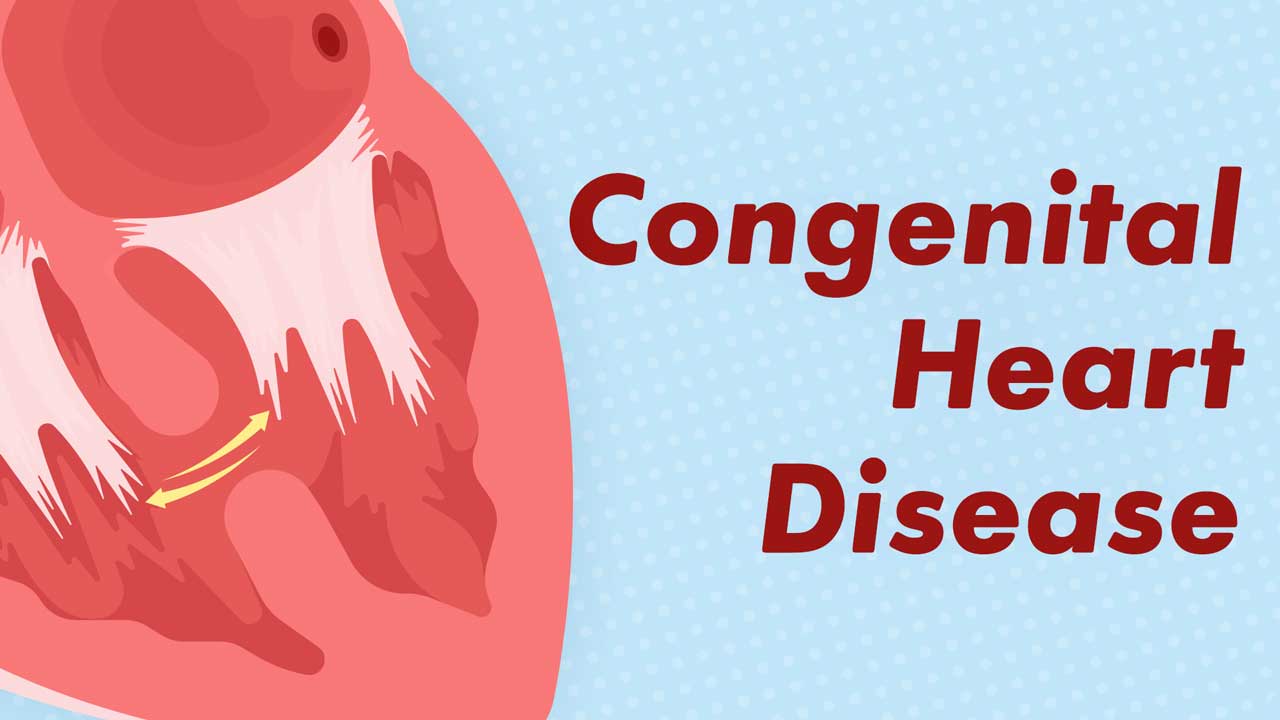 Congenital Heart Defects A Guide