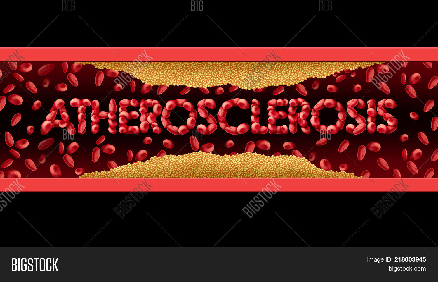 Atherosclerosis A Silent Threat