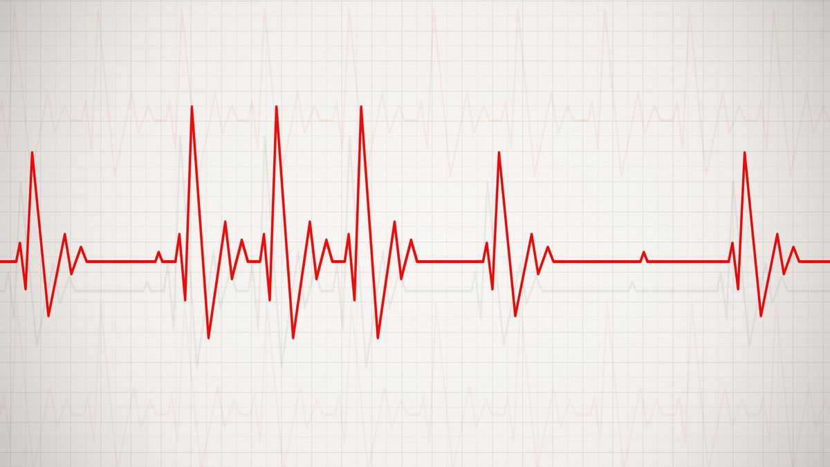 Arrhythmia An Irregular Heartbeat