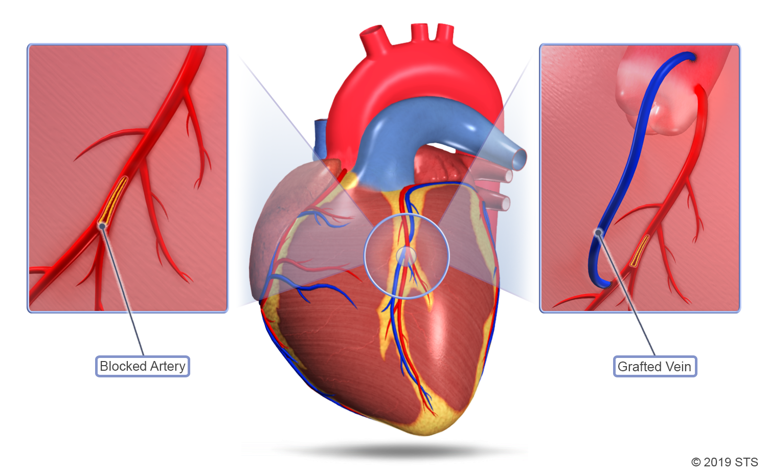 Coronary Artery Bypass Graft (CABG) A Surgical Procedure