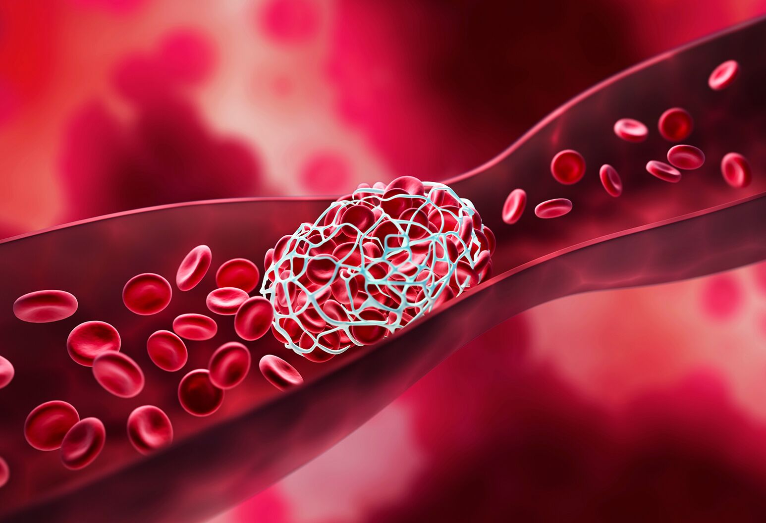 Blood Clots A Serious Health Concern