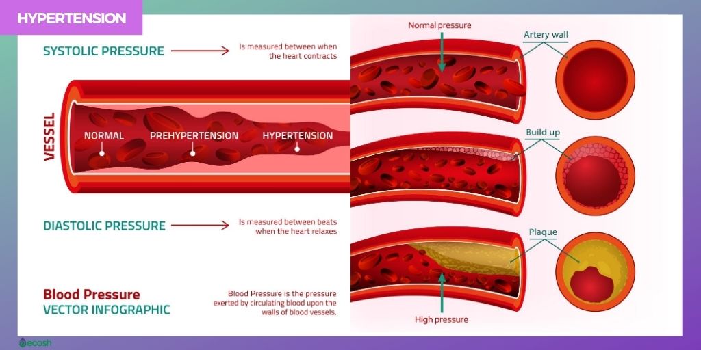 Hypertension A Silent Killer