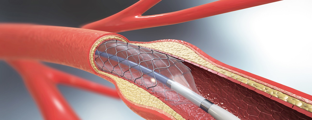 Angioplasty A Procedure to Open Blocked Arteries