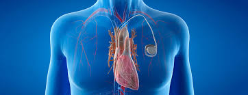 Pacemaker A Device to Regulate Heart Rhythm