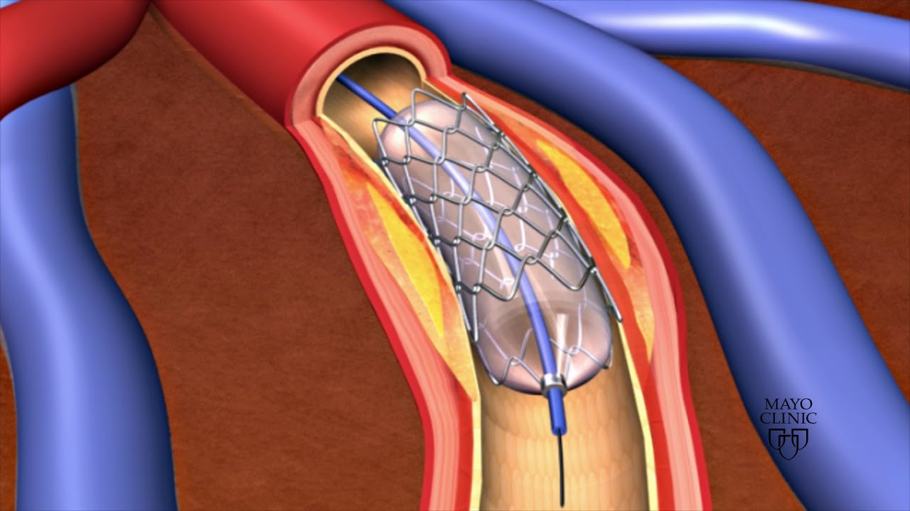 Stent Placement A Procedure to Open Blocked Arteries