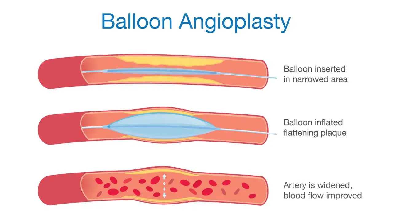 Stent Placement A Procedure to Open Blocked Arteries