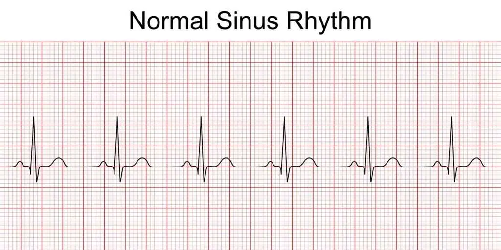 Electrocardiogram (ECG or EKG) A Window into Your Heart