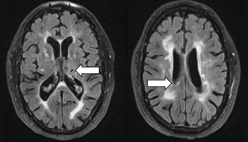 Vascular Cognitive Impairment