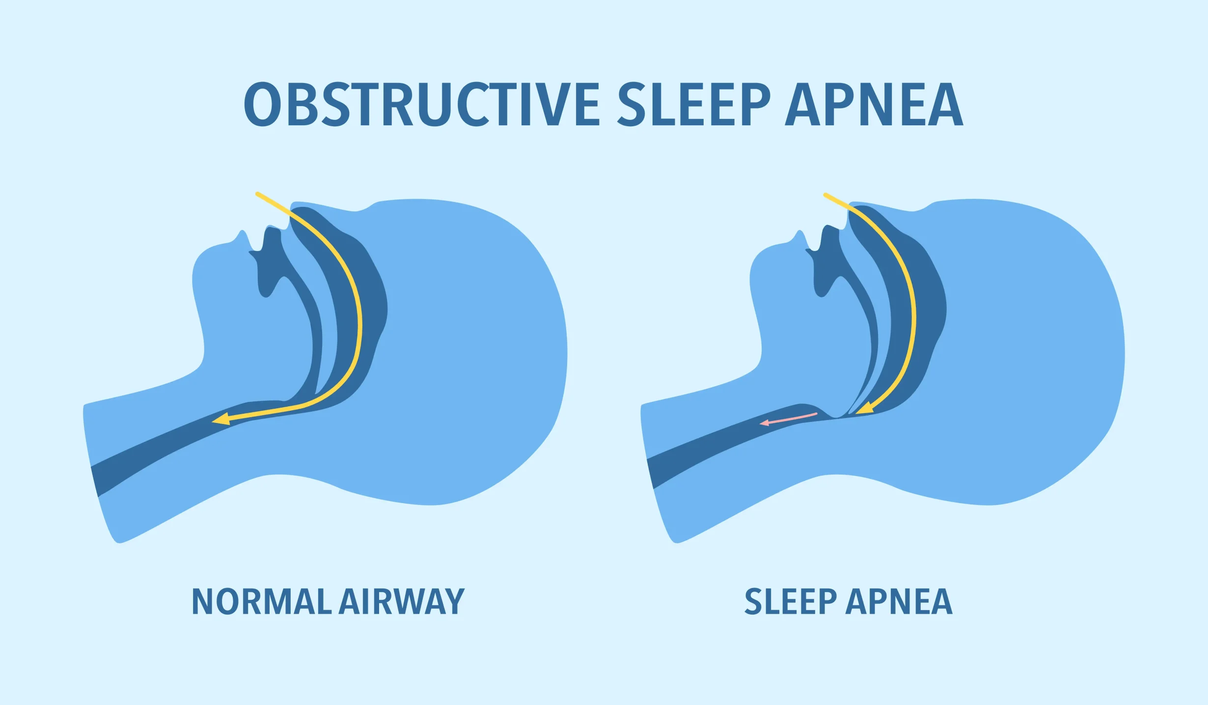 Obstructive Sleep Apnea